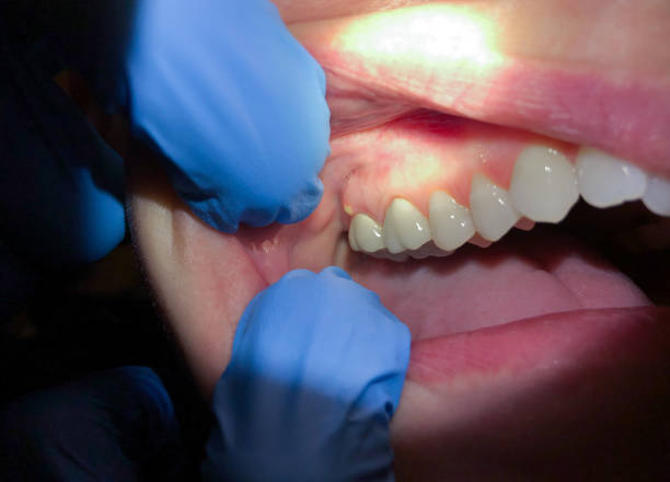 Best Emergency Dental Care for Abscessed Tooth in Black Canyon City, AZ
